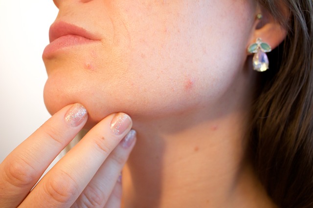 5 Sneaky Causes of Acne to Look Out&nbsp;For
